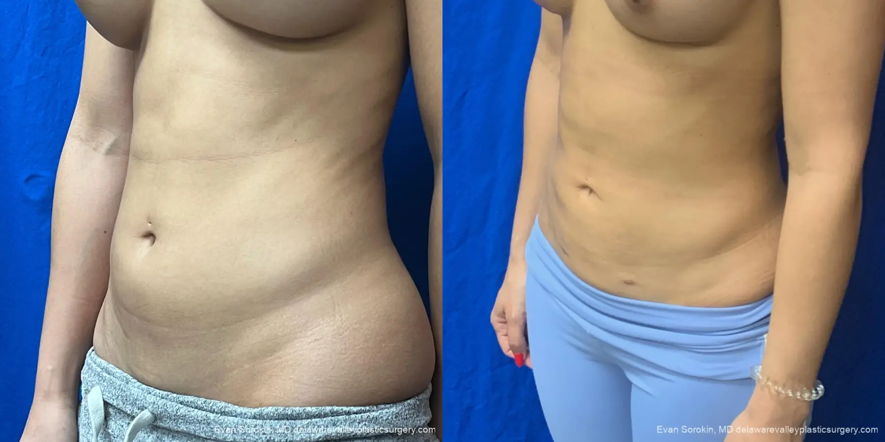 Liposuction: Patient 11 - Before and After 3