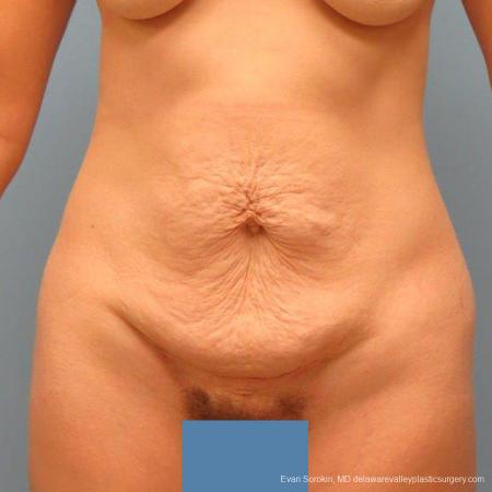 Philadelphia Abdominoplasty 9465 - Before Image 1
