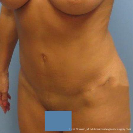 Philadelphia Abdominoplasty 9475 - After Image 4