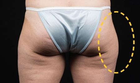 CoolSculpting®: Patient 10 - Before Image 1