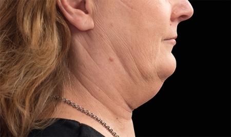 CoolSculpting®: Patient 6 - Before Image 1