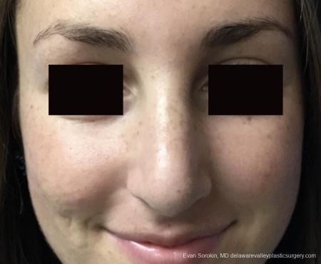 Rhinoplasty: Patient 2 - After Image 2