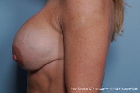 Philadelphia Breast Augmentation 8693 - Before and After Image 5
