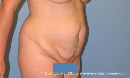 Philadelphia Abdominoplasty 10122 - Before Image 2