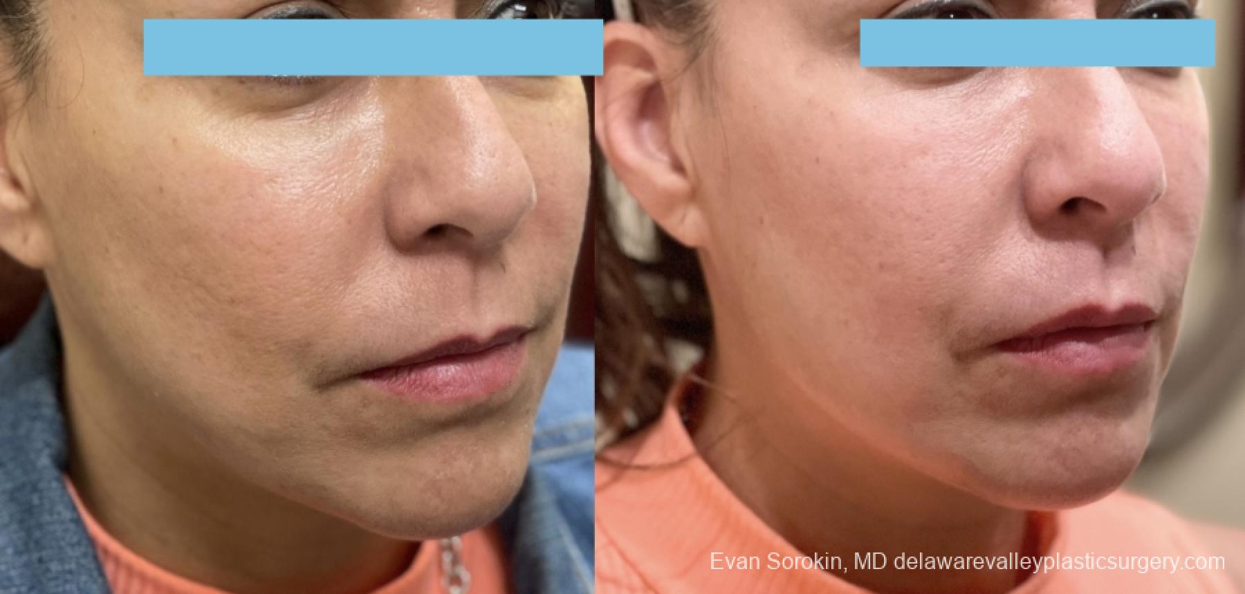 Fillers: Patient 45 - Before and After 