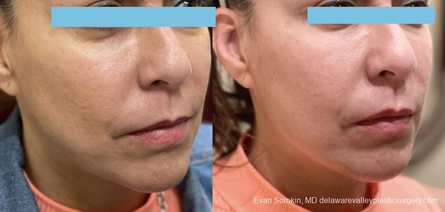 Fillers: Patient 45 - Before and After 1