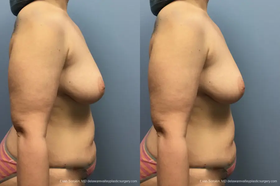Mommy Makeover: Patient 13 - Before and After 3
