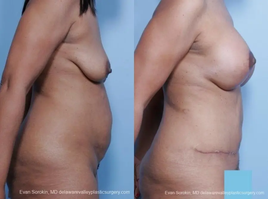 Philadelphia Mommy Makeover 8691 - Before and After 4