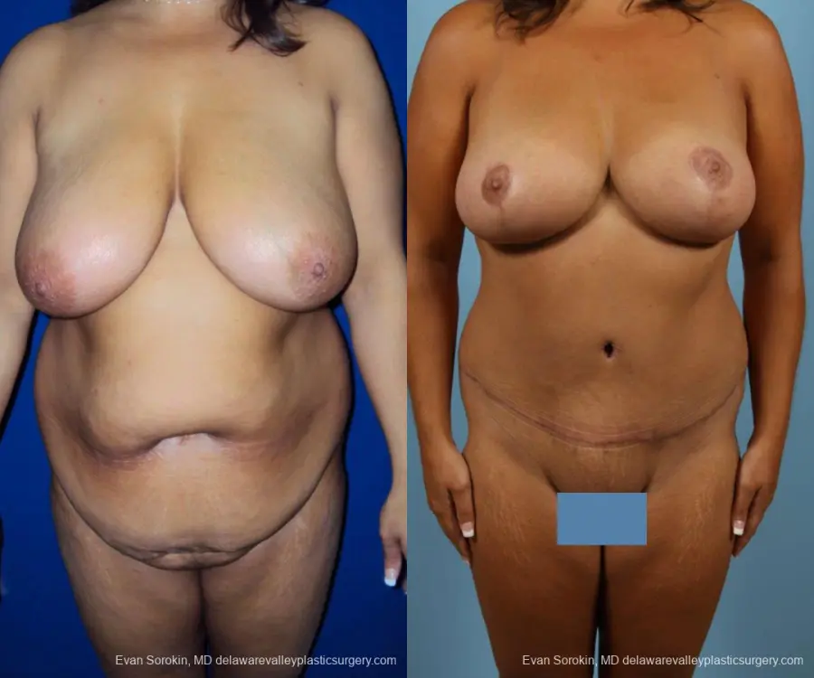 Philadelphia Mommy Makeover 9469 - Before and After 1