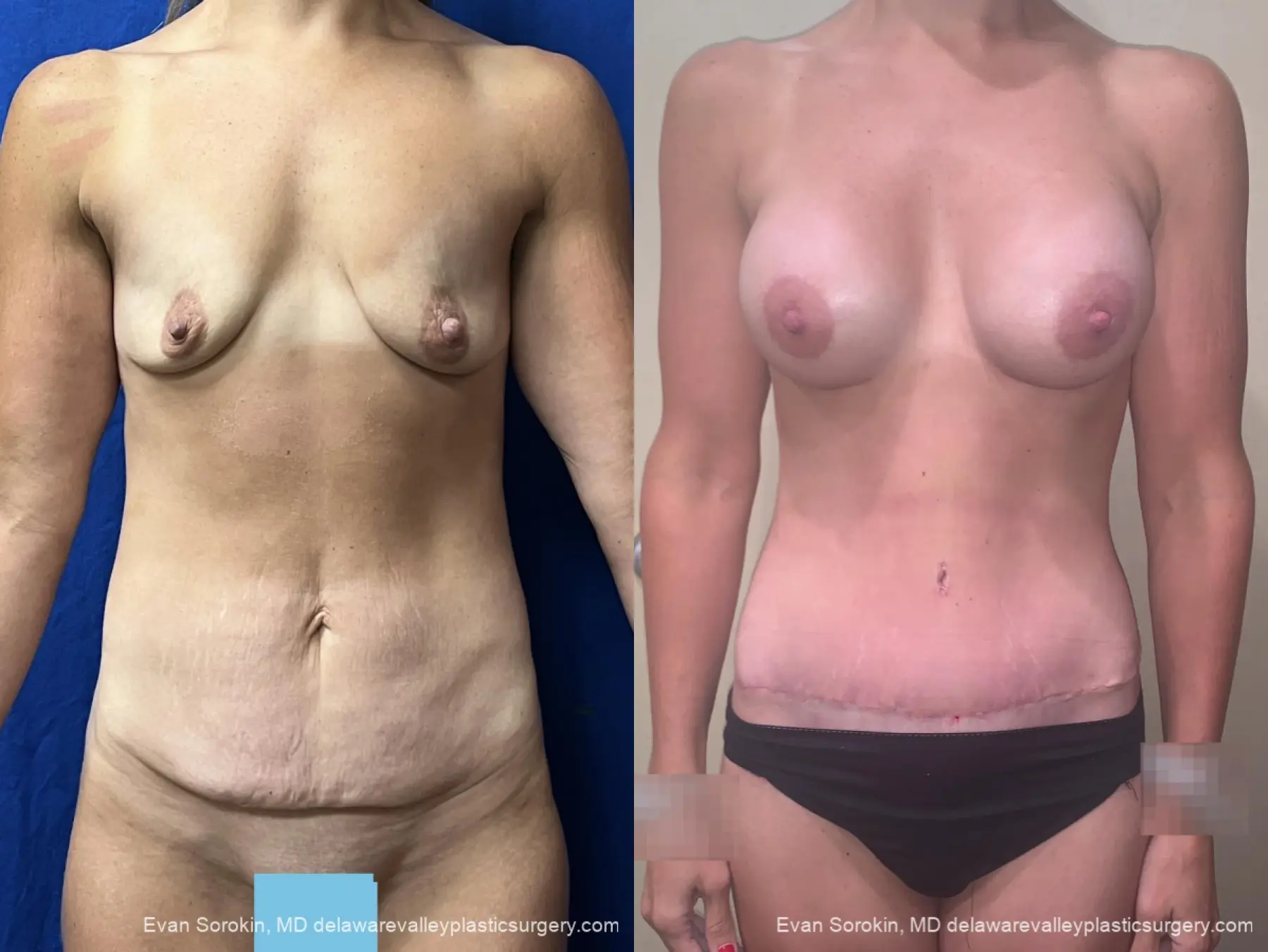 Mommy Makeover: Patient 2 - Before and After  