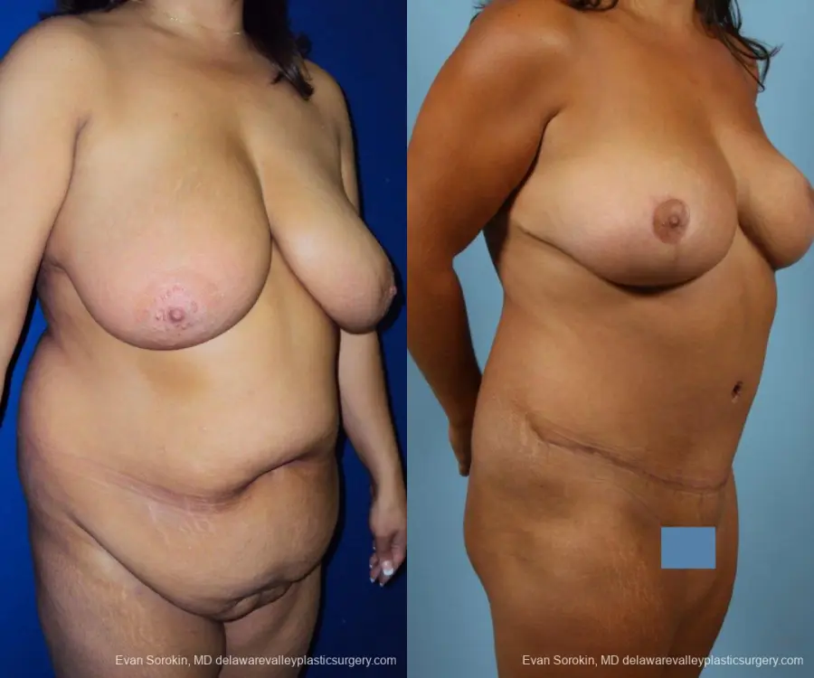 Philadelphia Mommy Makeover 9469 - Before and After 2