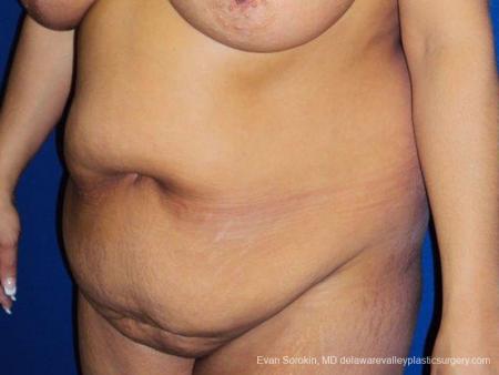 Philadelphia Abdominoplasty 9471 - Before Image 4