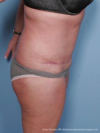 Philadelphia Abdominoplasty 9463 - After Image 3