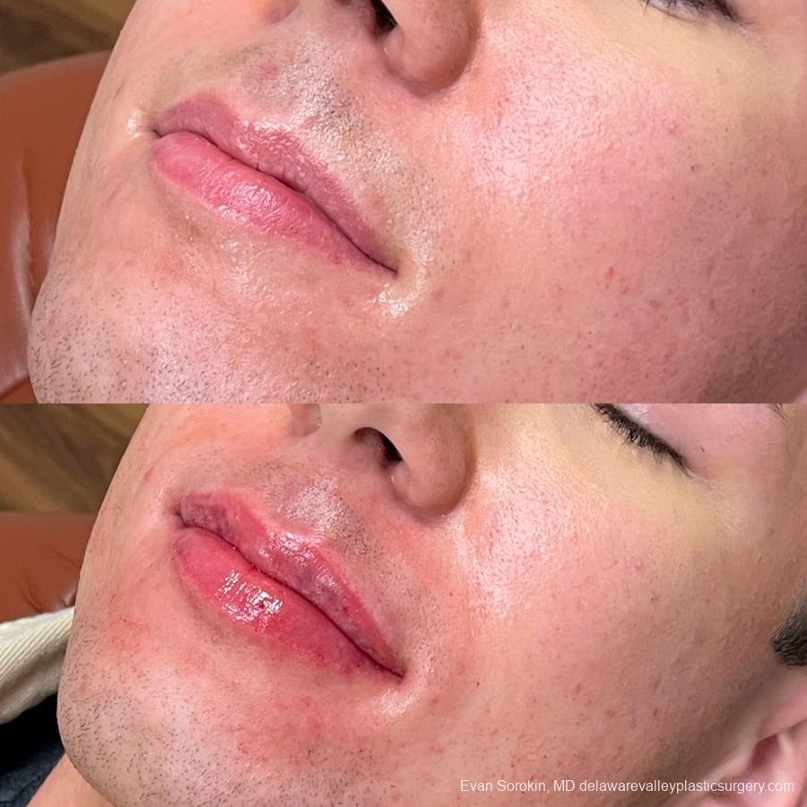 Lip Augmentation: Patient 53 - Before and After 3