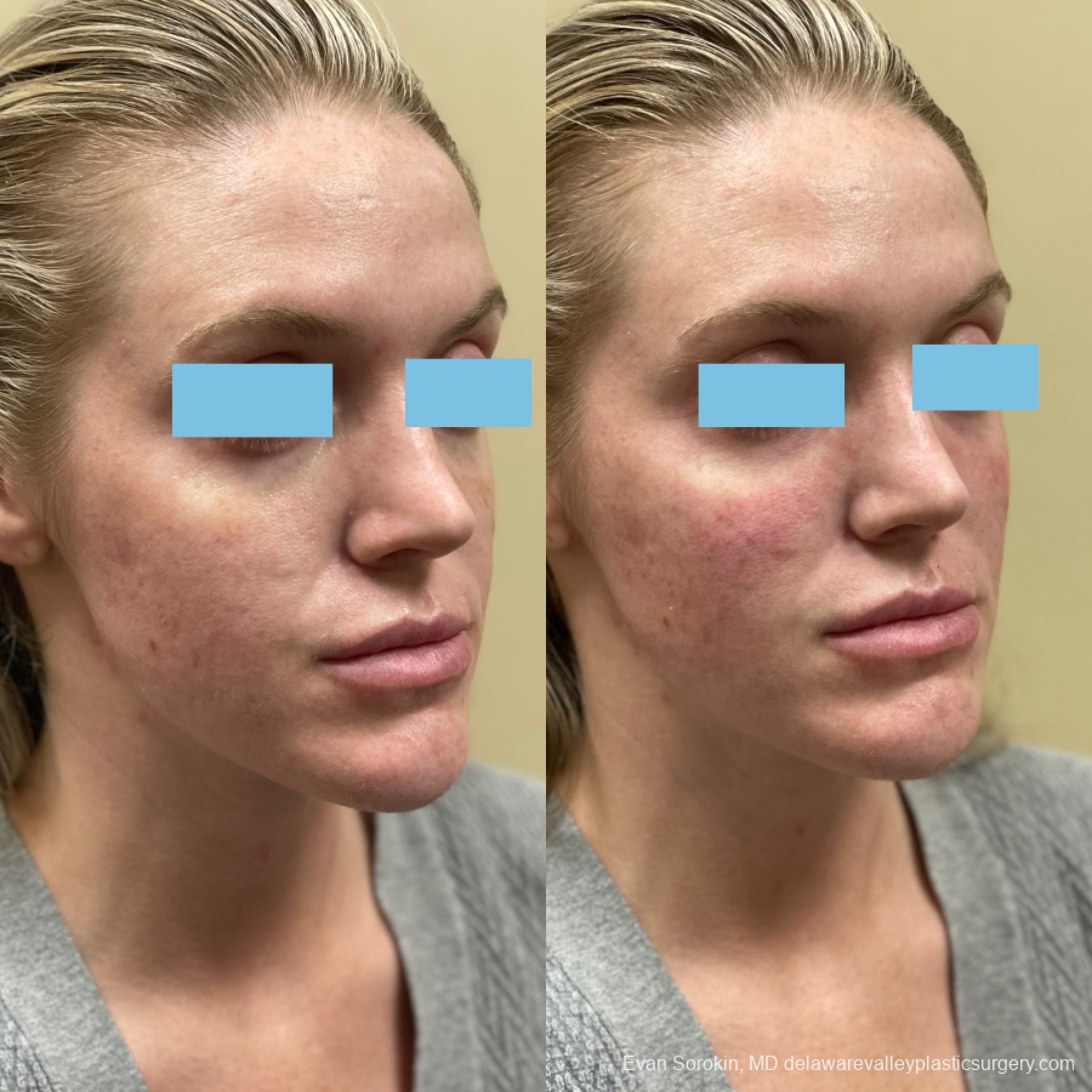 Fillers: Patient 46 - Before and After 