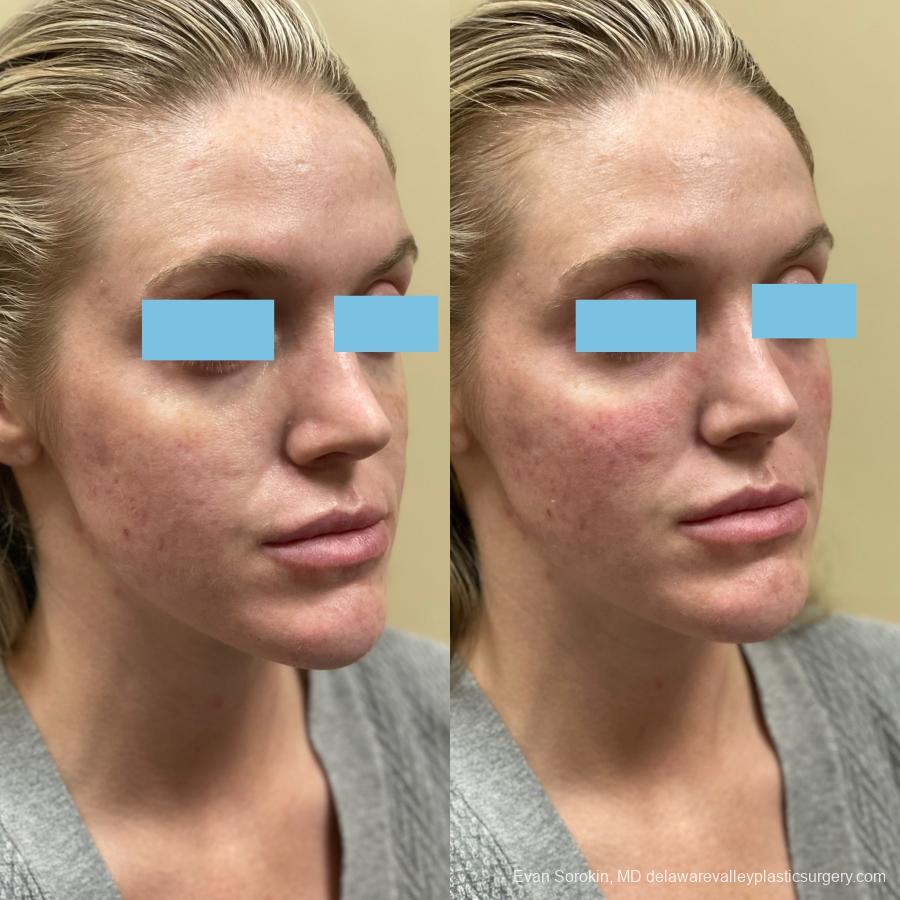 Fillers: Patient 46 - Before and After 1