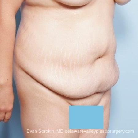 Philadelphia Abdominoplasty 8678 - Before Image 2