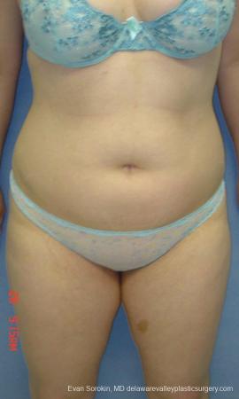 Philadelphia Liposuction 9480 - Before Image 1