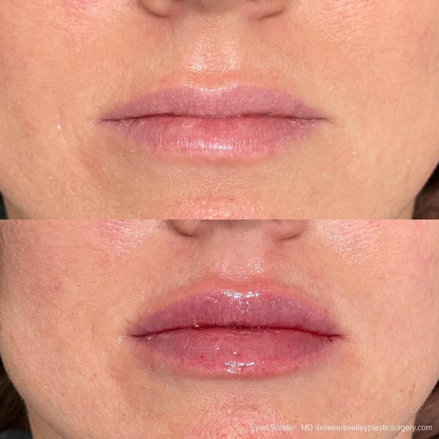 Lip Filler: Patient 65 - Before and After 1
