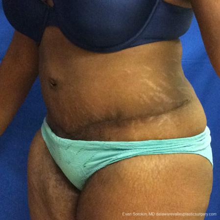 Philadelphia Abdominoplasty 10817 - After Image 4