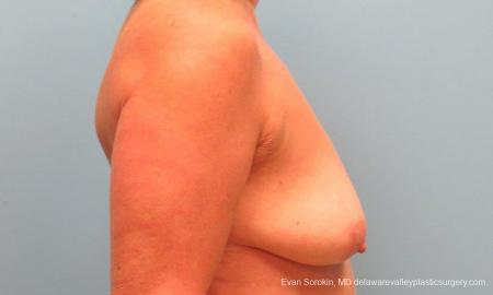 Philadelphia Breast Lift and Augmentation 9598 - Before Image 3