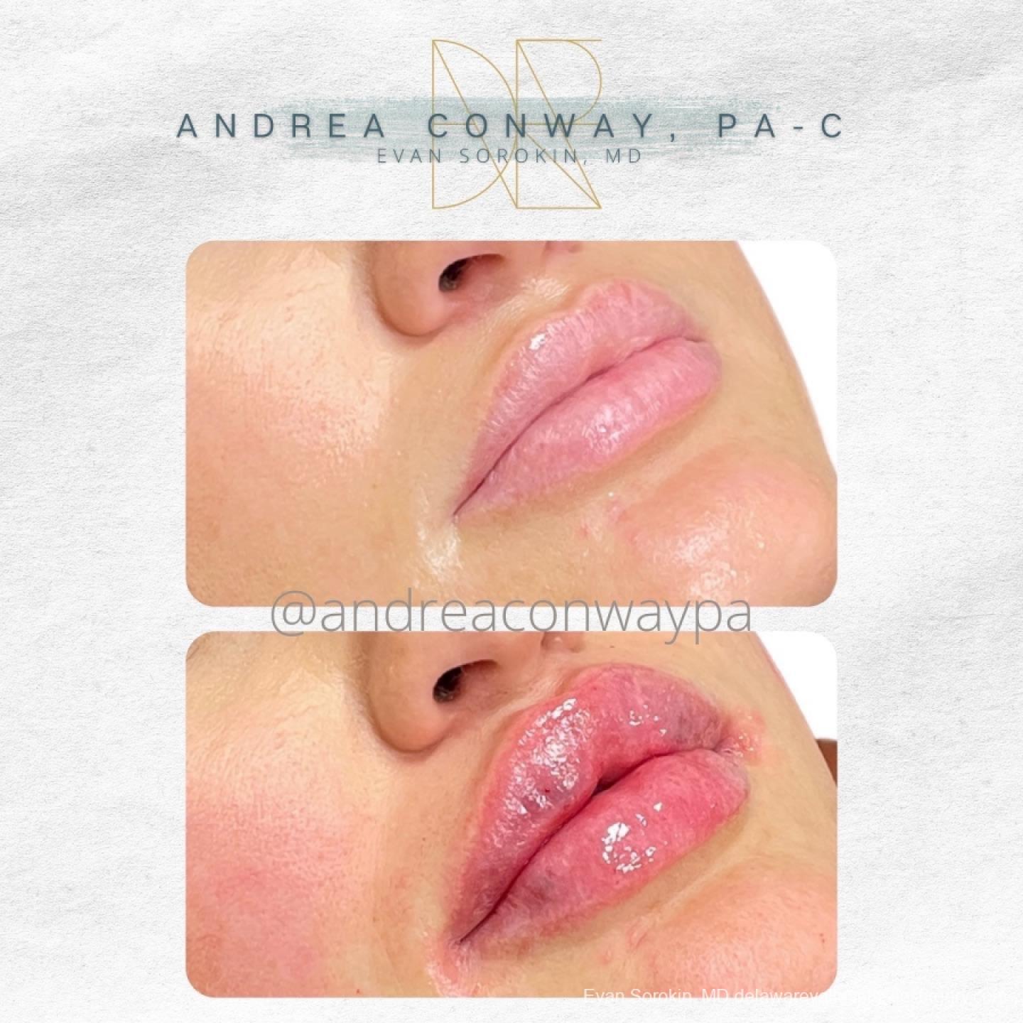 Lip Augmentation: Patient 50 - Before and After 2