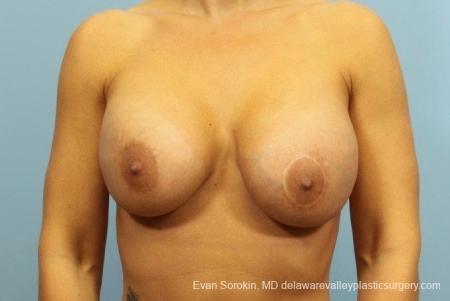 Philadelphia Breast Augmentation 8709 - Before Image 1