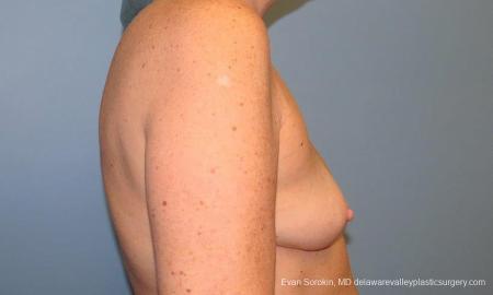 Philadelphia Breast Augmentation 9600 - Before Image 3