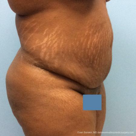 Philadelphia Abdominoplasty 10817 - Before Image 2