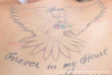 Philadelphia Tattoo Removal 8645 - Before Image 1