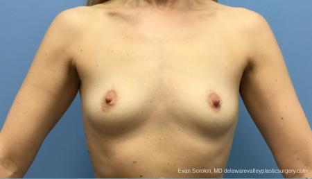 Philadelphia Breast Augmentation 12520 - Before Image 1