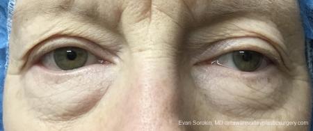 Blepharoplasty: Patient 2 - Before Image 1