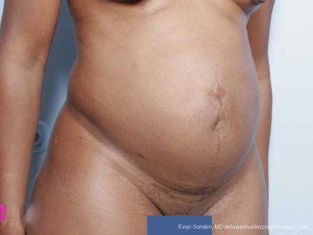 Philadelphia Abdominoplasty 9339 - Before Image 2