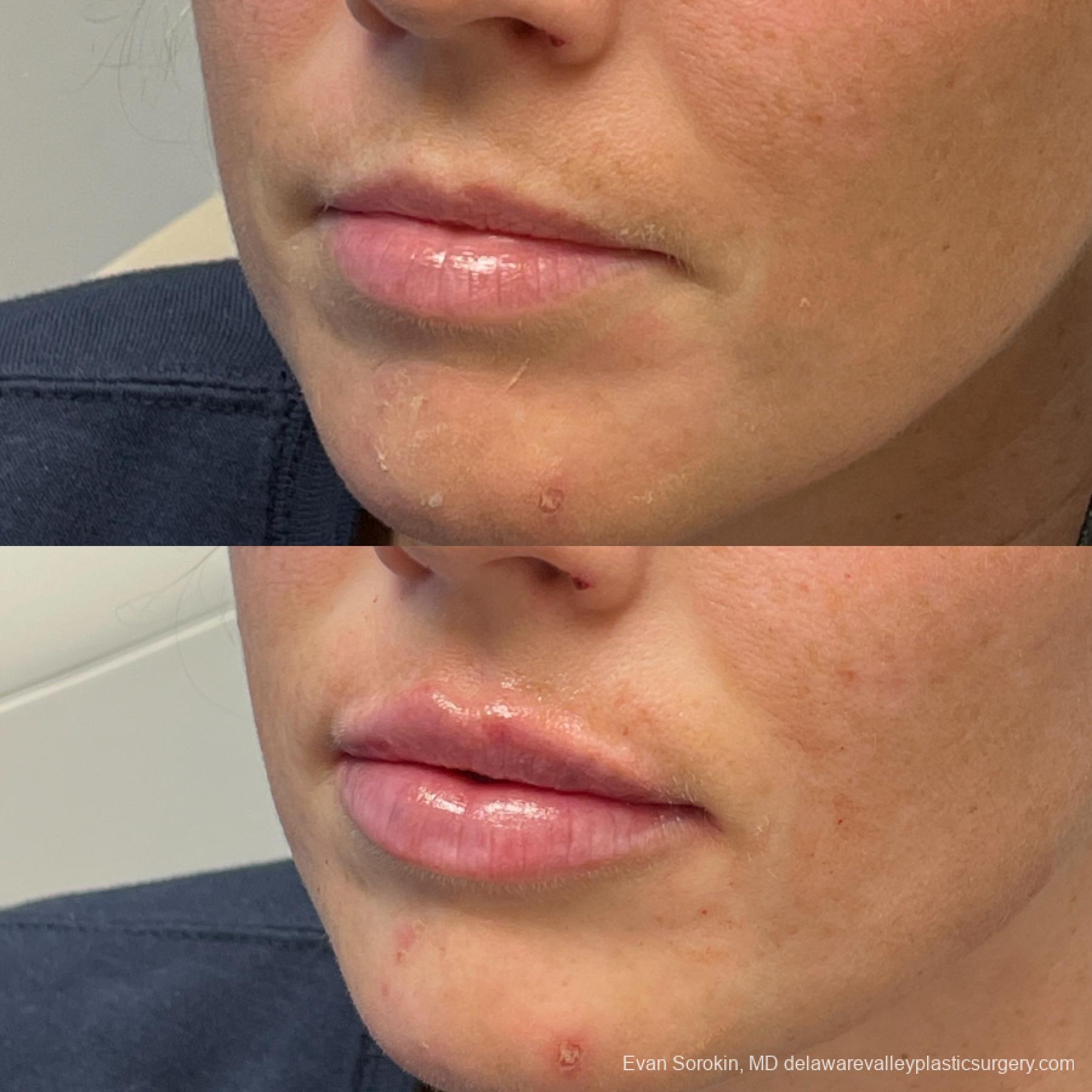 Fillers: Patient 27 - Before and After 3