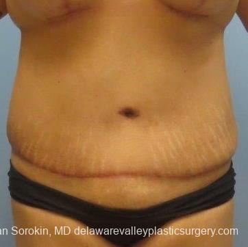 Philadelphia Abdominoplasty 8678 - After Image 1