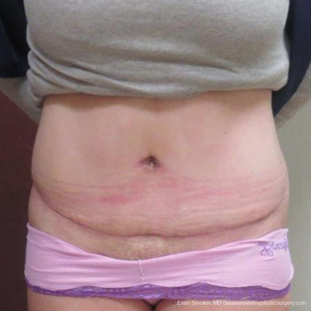 Philadelphia Abdominoplasty 9267 - After Image 1