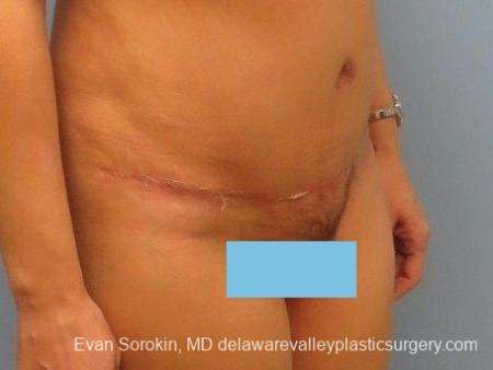 Philadelphia Abdominoplasty 8672 - After Image 2