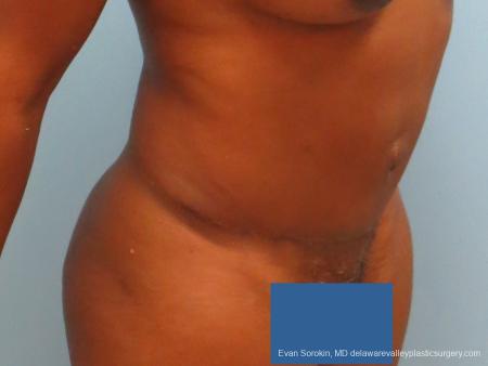 Philadelphia Abdominoplasty 9339 - After Image 2
