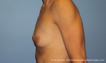 Philadelphia Breast Augmentation 10248 - Before and After Image 5