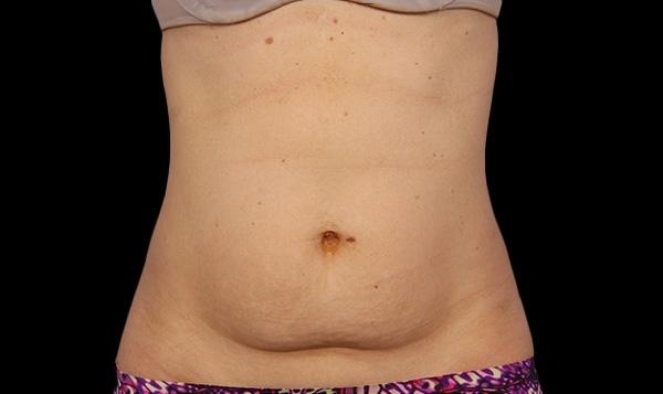 CoolSculpting®: Patient 1 - Before 