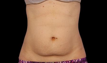 CoolSculpting®: Patient 1 - Before Image 1