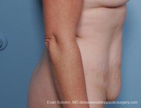 Philadelphia Abdominoplasty 9315 - Before and After Image 5