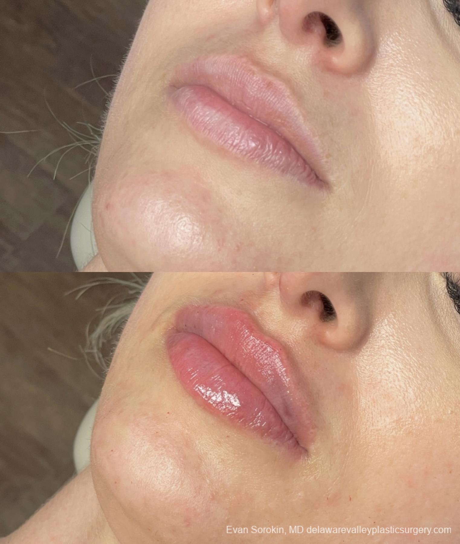 Lip Augmentation: Patient 57 - Before and After 3