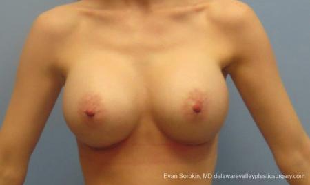 Philadelphia Breast Augmentation 8781 - After Image 1