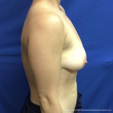 Breast Lift And Augmentation: Patient 3 - Before Image 3