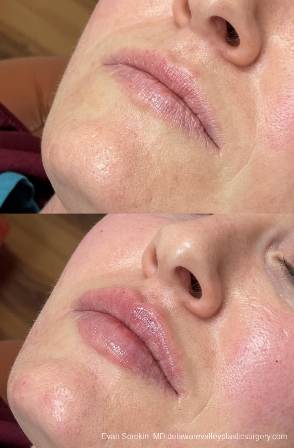 Lip Augmentation: Patient 46 - Before and After 3