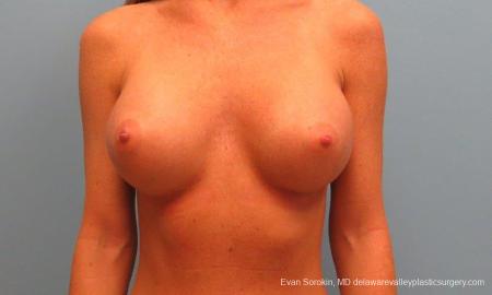 Philadelphia Breast Augmentation 9179 - After Image 1