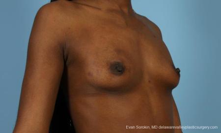 Philadelphia Breast Augmentation 8655 - Before Image 2
