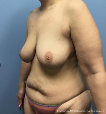 Mommy Makeover: Patient 13 - Before Image 2