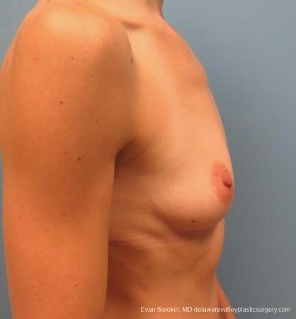 Philadelphia Breast Augmentation 8823 - Before Image 4
